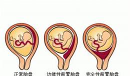 二胎媽媽應(yīng)該知道這個(gè)，前置胎盤太危險(xiǎn)！欽州市二醫(yī)院成功救治兇險(xiǎn)性前置胎盤產(chǎn)婦